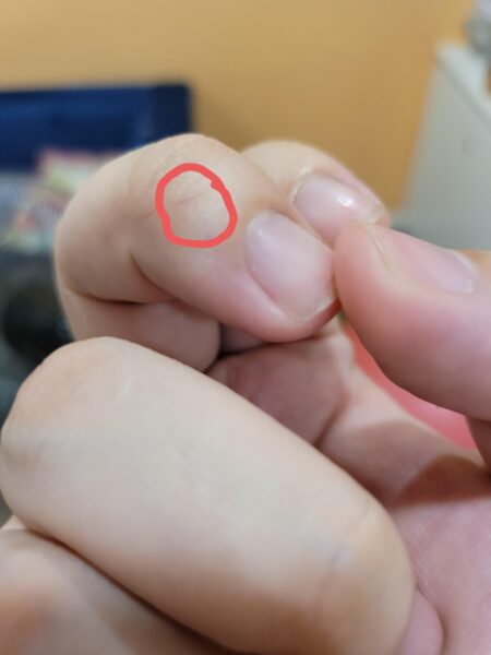 Hình ảnh bị đứt tay troll đầu ngón tay