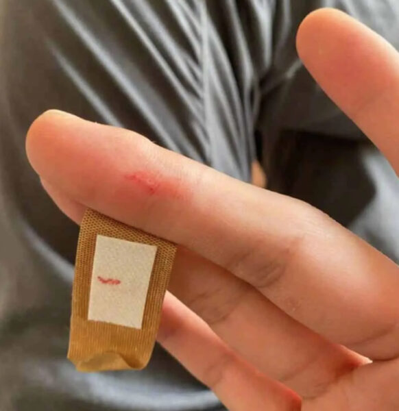 Hình ảnh bị đứt tay troll mở băng cá nhân